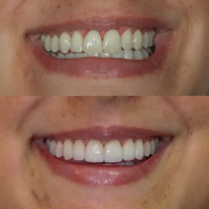 antes-e-depois-1